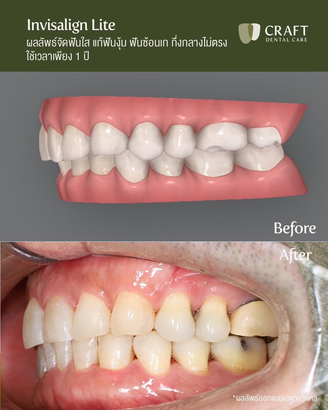 Craft Dental Care คลินิกทันตกรรมคราฟท์ เดนทัล แคร์ | Facebook