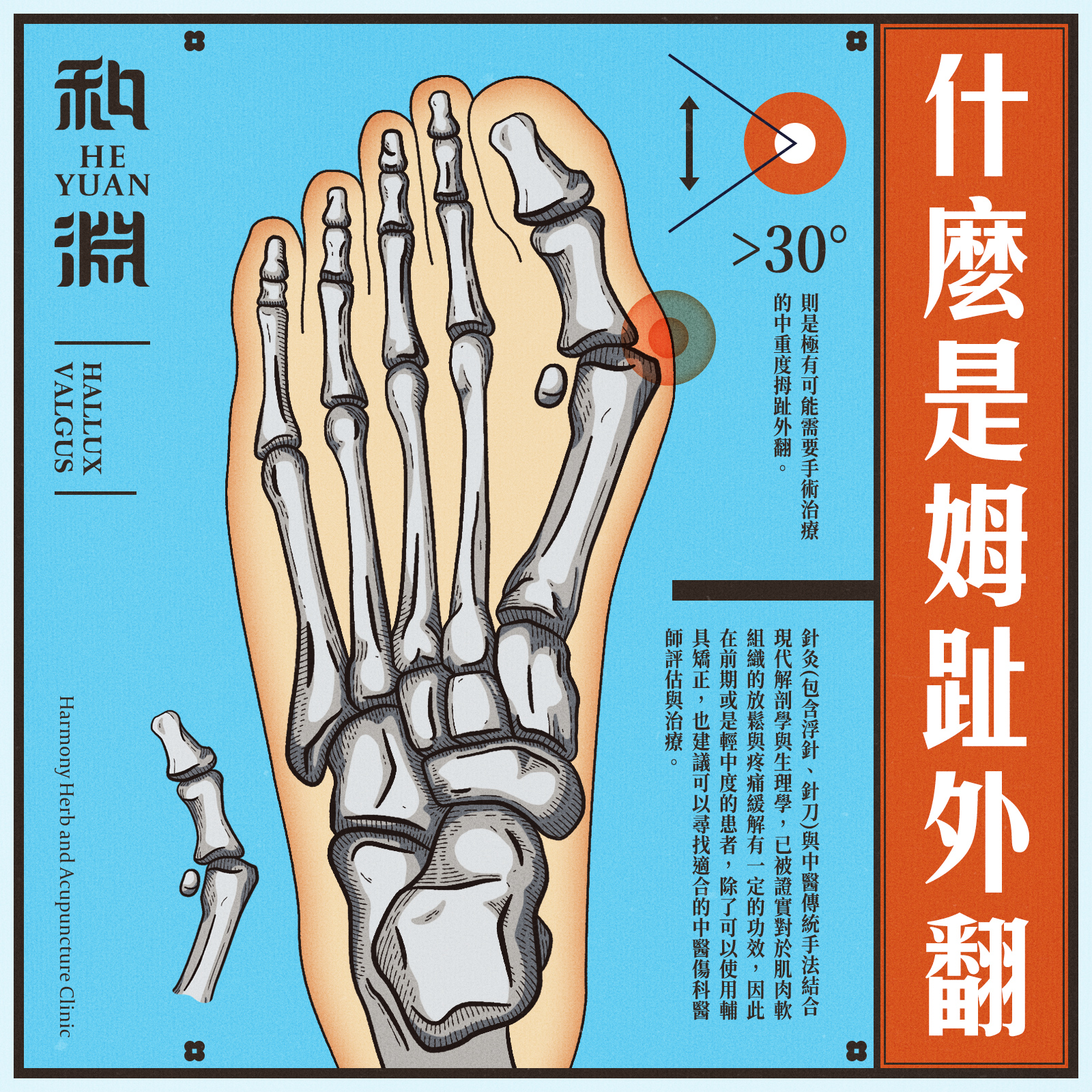 和淵中醫診所 - 【什麼是姆趾外翻？】 文：和淵中醫診所-- 陳柏恩醫師 -- 拇趾外翻，指的是足部大拇趾關節處有異常的成角畸形並歪向第二趾 ...