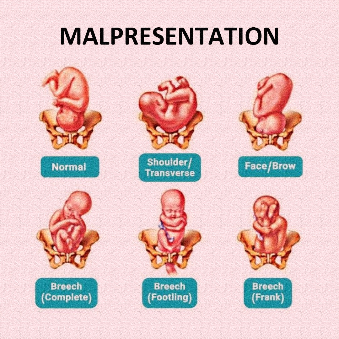 BABY MALPRESENTATION 🔹 Baby not... - Pregnancy & Parenting | Facebook