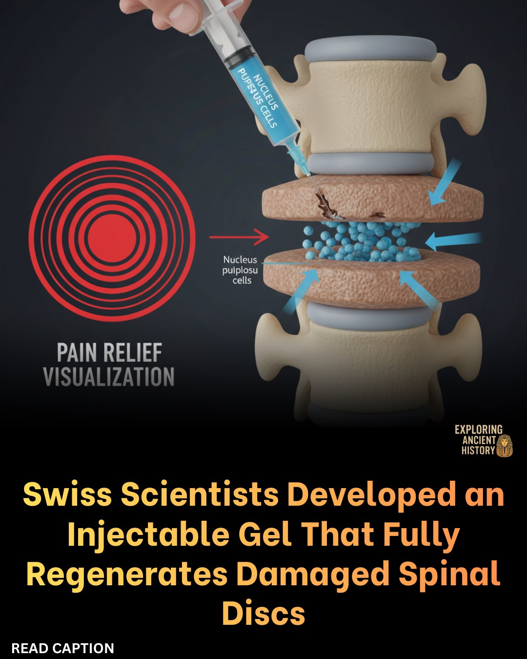 factopia-a-tiny-injection-may-restore-spinal-health-previously