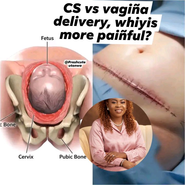 what hurts more lipo or c-section Which Is Painful, Liposuction Tummy Tuck 2026 Patient Compares C-Section Pain To