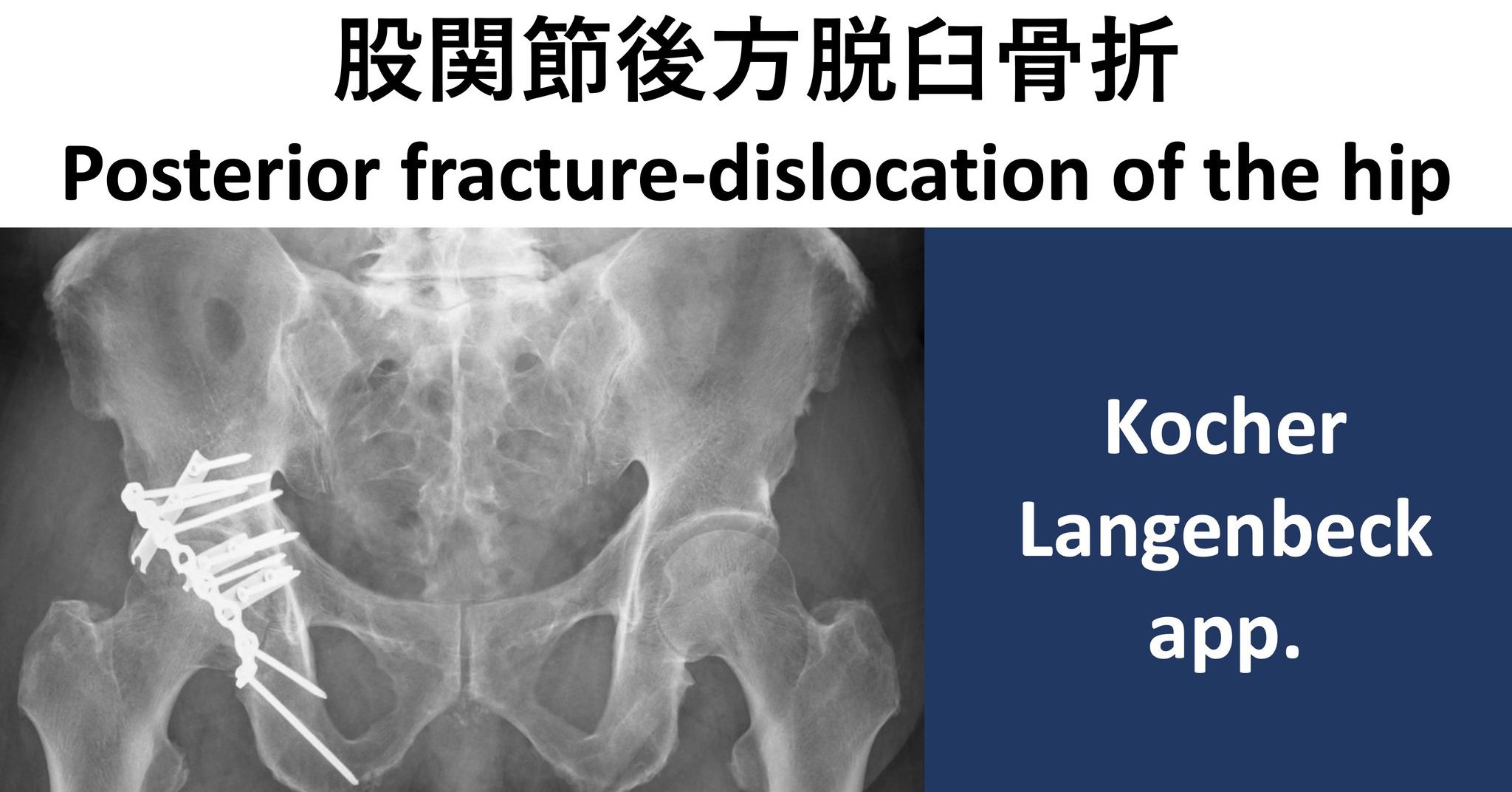 股関節後方脱臼骨折に対するORIF ORIF for posterior wall fracture of