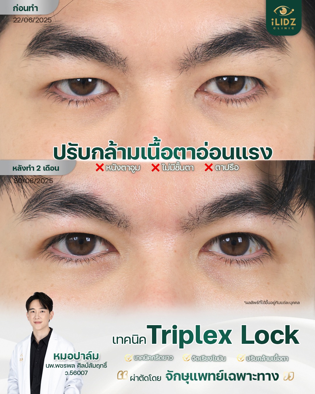ILIDZ - จากตาปรือ หนังตาตก ดวงตาดูเปิด สดใสขึ้น ปรับกล้ามเนื้อตาอ่อนแรง ...