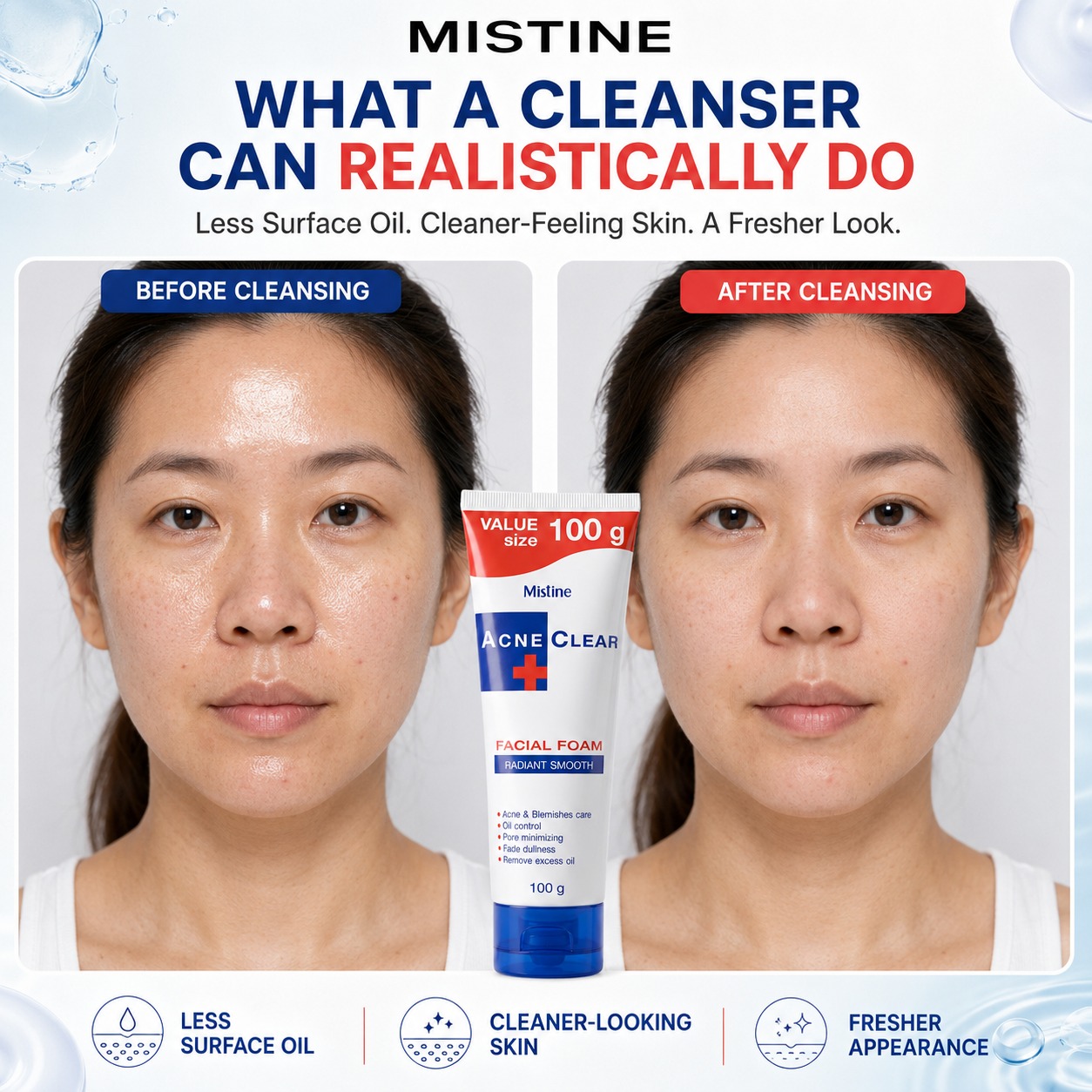 Mistine Acne Clear Facial Foam 100 g A globally popular facial cleanser with over 100 million units sold worldwide, delivering deep cleansing and helping control excess oil for clear, radiant skin. #Mistine #