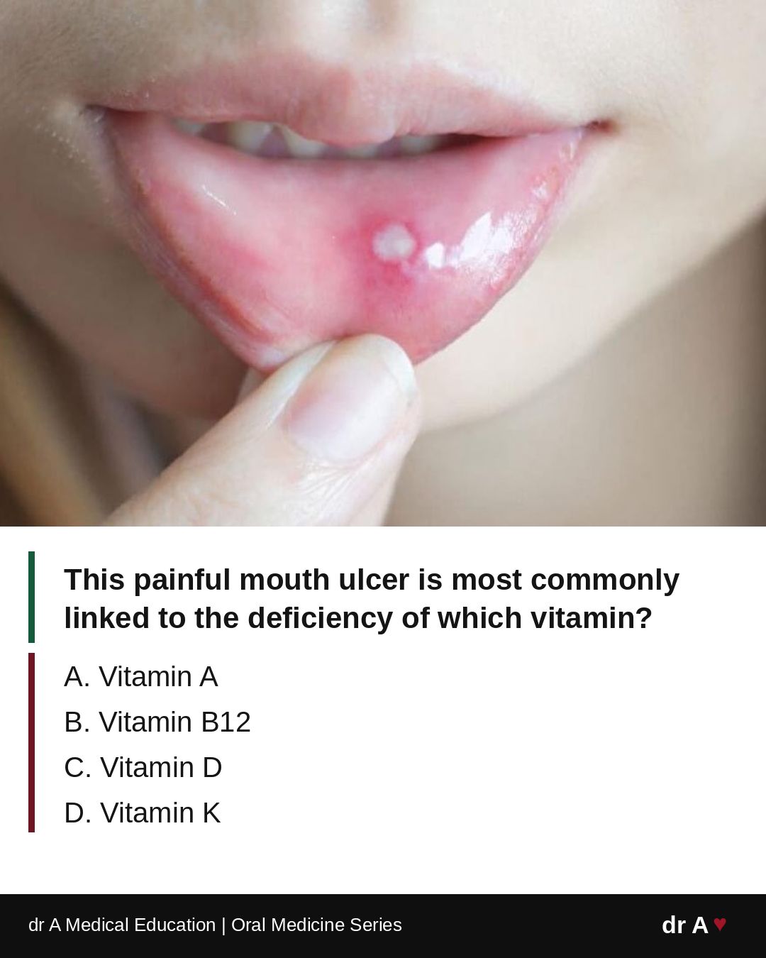What vitamin deficiency causes mouth ulcers?