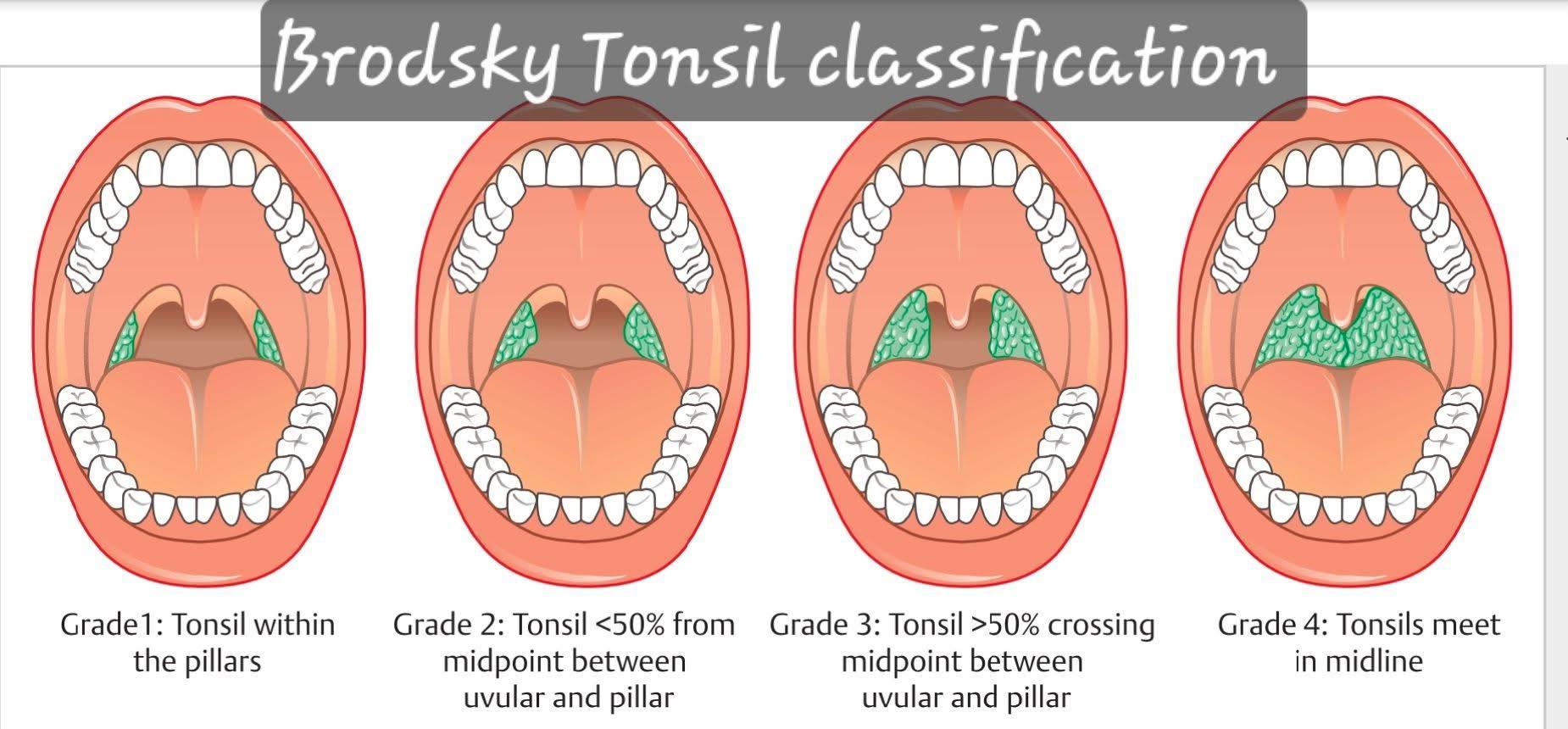 The Brodsky tonsil classification It... - Dr K M Reza-Ul-Haq | Facebook