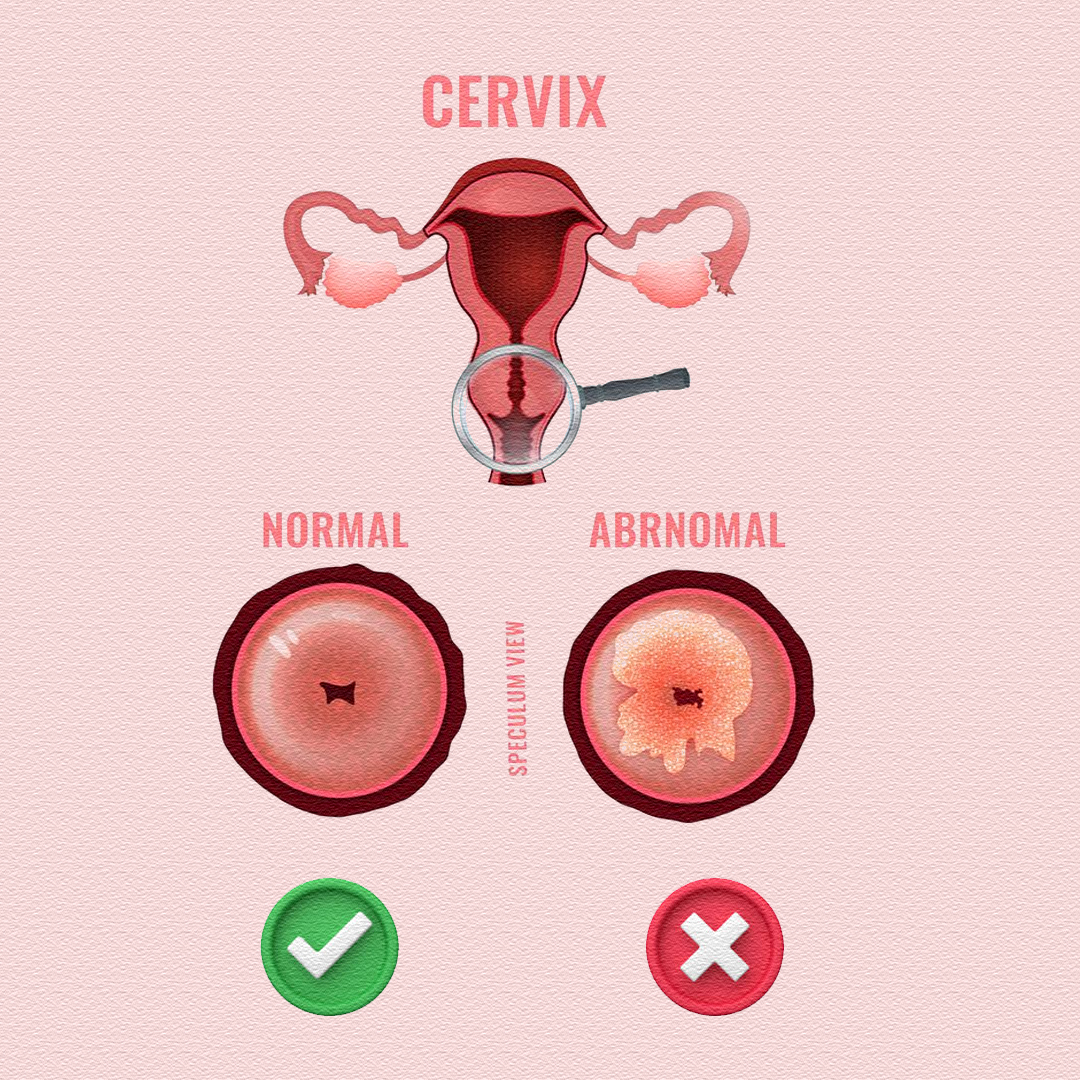 Pregnancy - NORMAL CERVIX 🧡🤰 WHAT IT LOOKS LIKE 🔒 Firm, closed, and ...