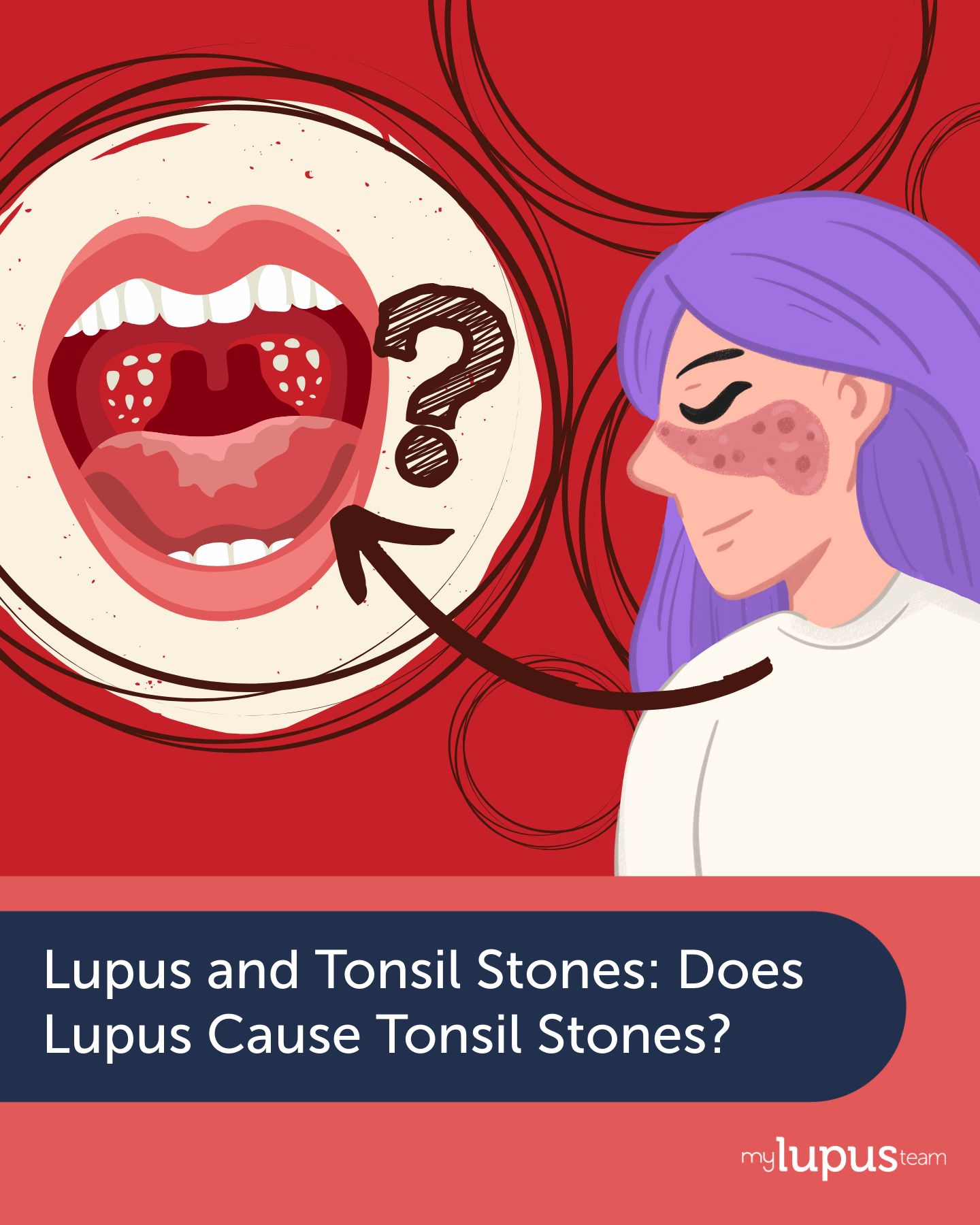MyLupusTeam - Along with traditional #lupus symptoms like skin rashes ...