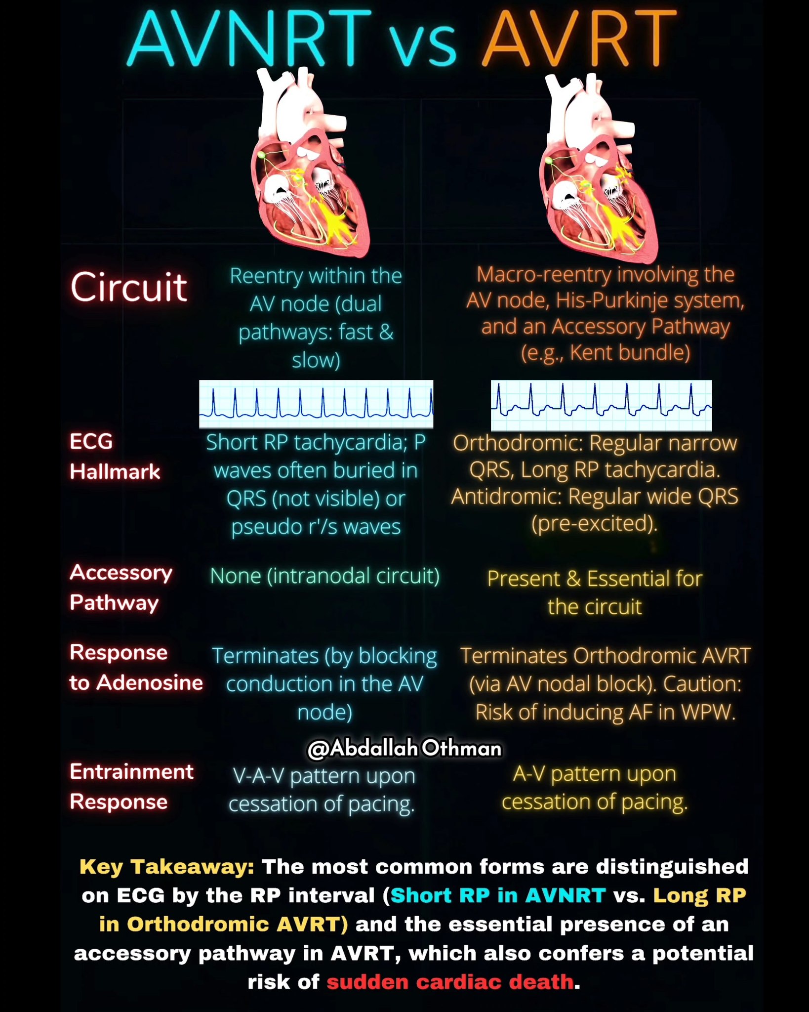 Anatomy and physiology breakdown and terminology | 🔍 AVNRT vs. AVRT ...