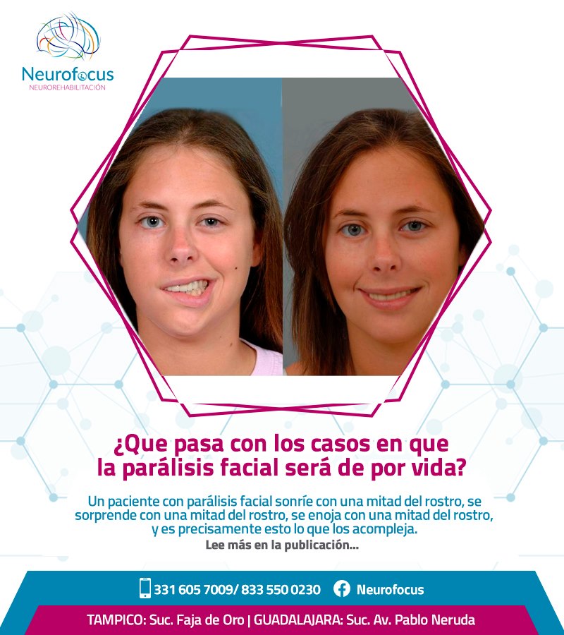 Neurofocus - Para los casos de parálisis facial de por... | Facebook