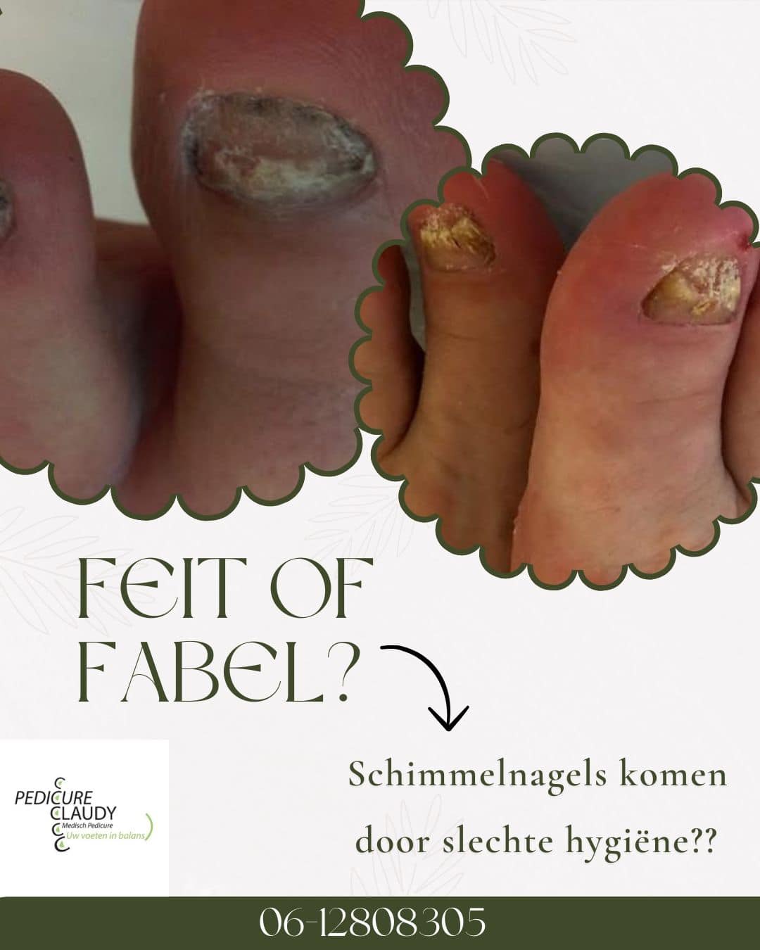 pedicure-feit-of-fabel-schimmelnagels-komen-door-slechte-hygi-ne