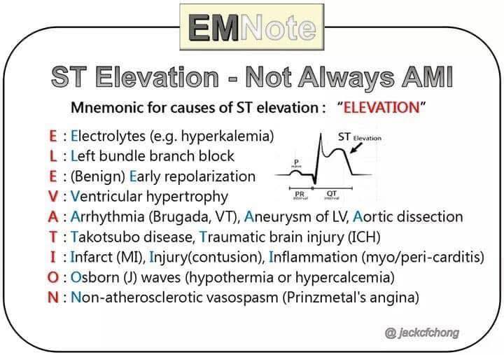 Nice graphic- ST Elevation #ecg... - Paramedics on Facebook | Facebook