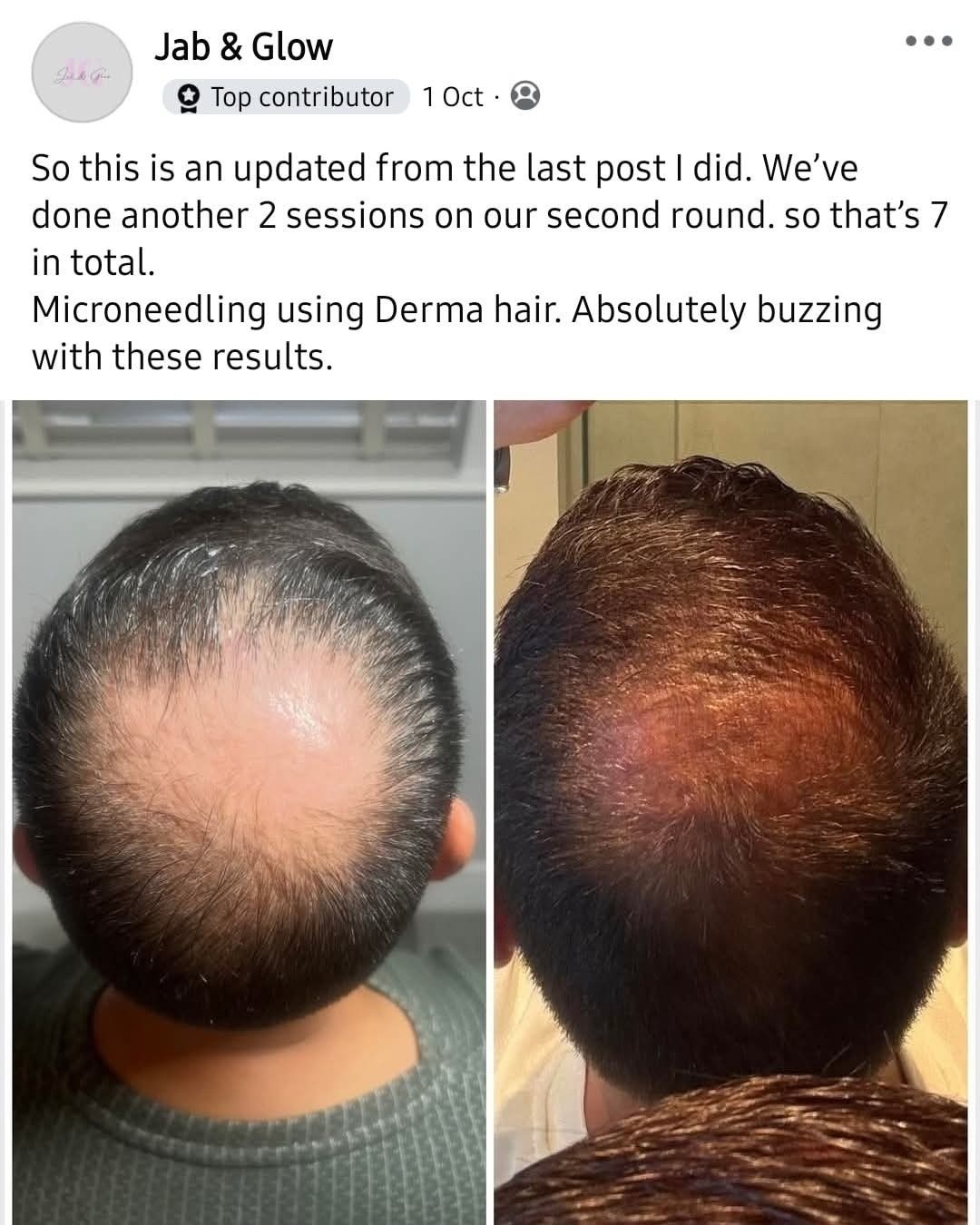 topical l carnitine hair loss Care Derma Activate Lotion is an intense healing treatment that helps reduce temporary and thinning hair. Caffeine stimulates the blood circulations, to nourish the scalp, resulting in a longer growth Flavor:Apple Bomb SS Best Sellers L-Carnitine 1000mg Tablets, Energy