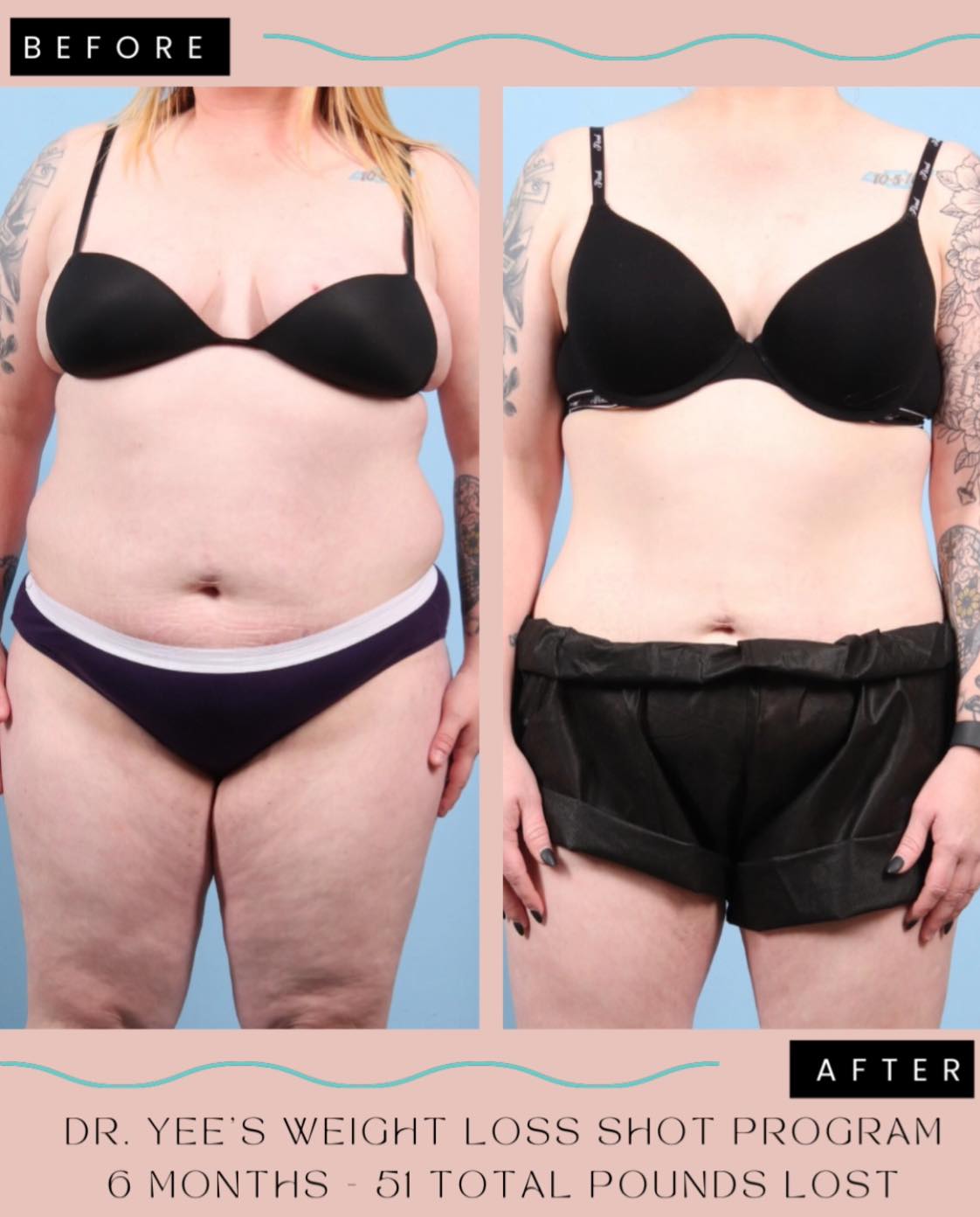 b12 injections weight loss before and after SHOT promo through the month of April! Call TODAY to schedule!📲 501-224-1044💻 www.DrSuzanneYee.com #dryee #dryeeme #weightloss #BodySlimming #BodySculpting #ozempic #weightlossshot #medspa #littlerock #arkansas #B12 #B12shot Lidocaine 1% Multiple Dose Lot #:Lot #: N95A1MQ10/0428 SLU32 Peptide | Research