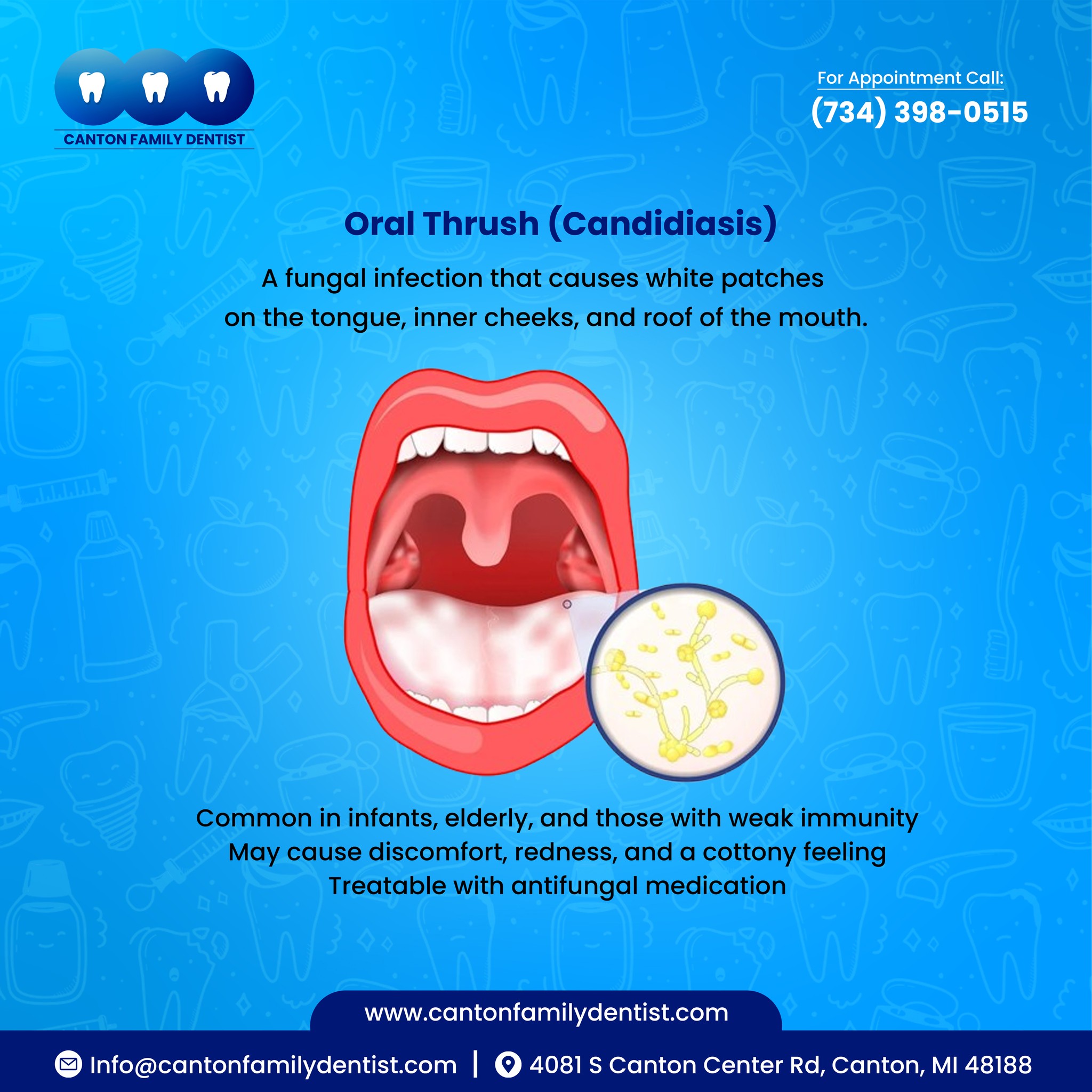 Canton - Oral Thrush (Candidiasis) A fungal infection that causes white ...
