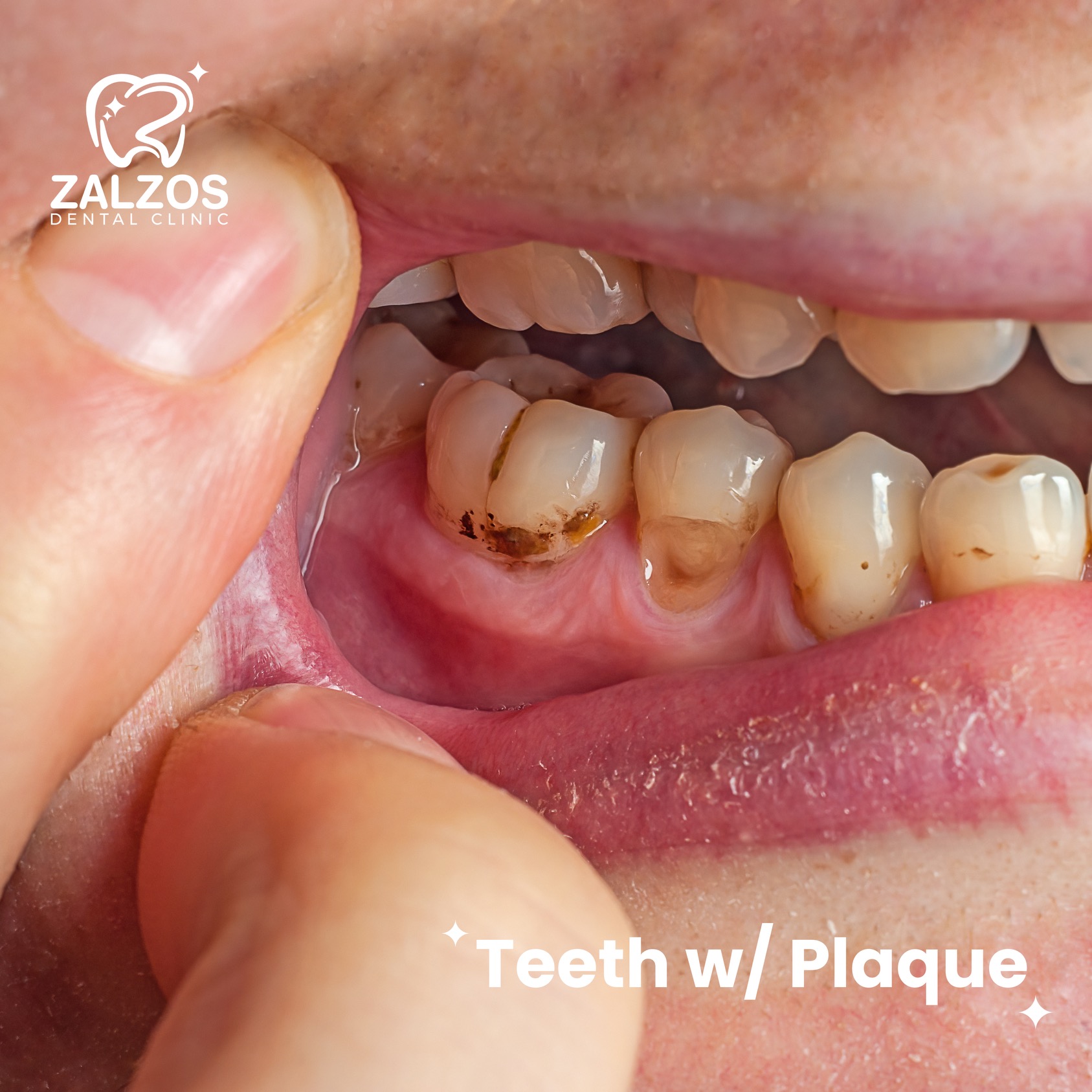🦷 Plaque buildup can lead to... - Zalzos Dental Clinic | Facebook