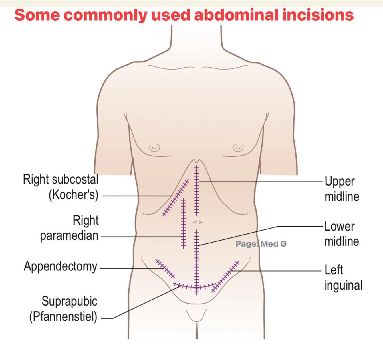 Medical - Abdominal Incisions made easy | Facebook