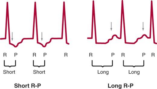 Cardiophilia - Why is the RP interval short in AVNRT but... | Facebook