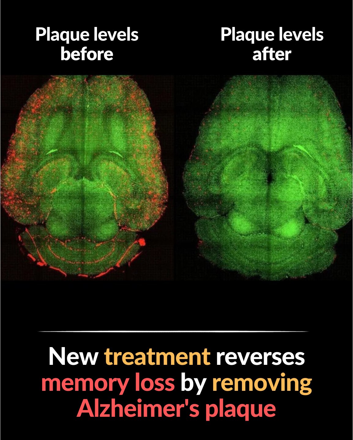 Anonymous - 🧠 Scientists reverse Alzheimer’s symptoms using ...