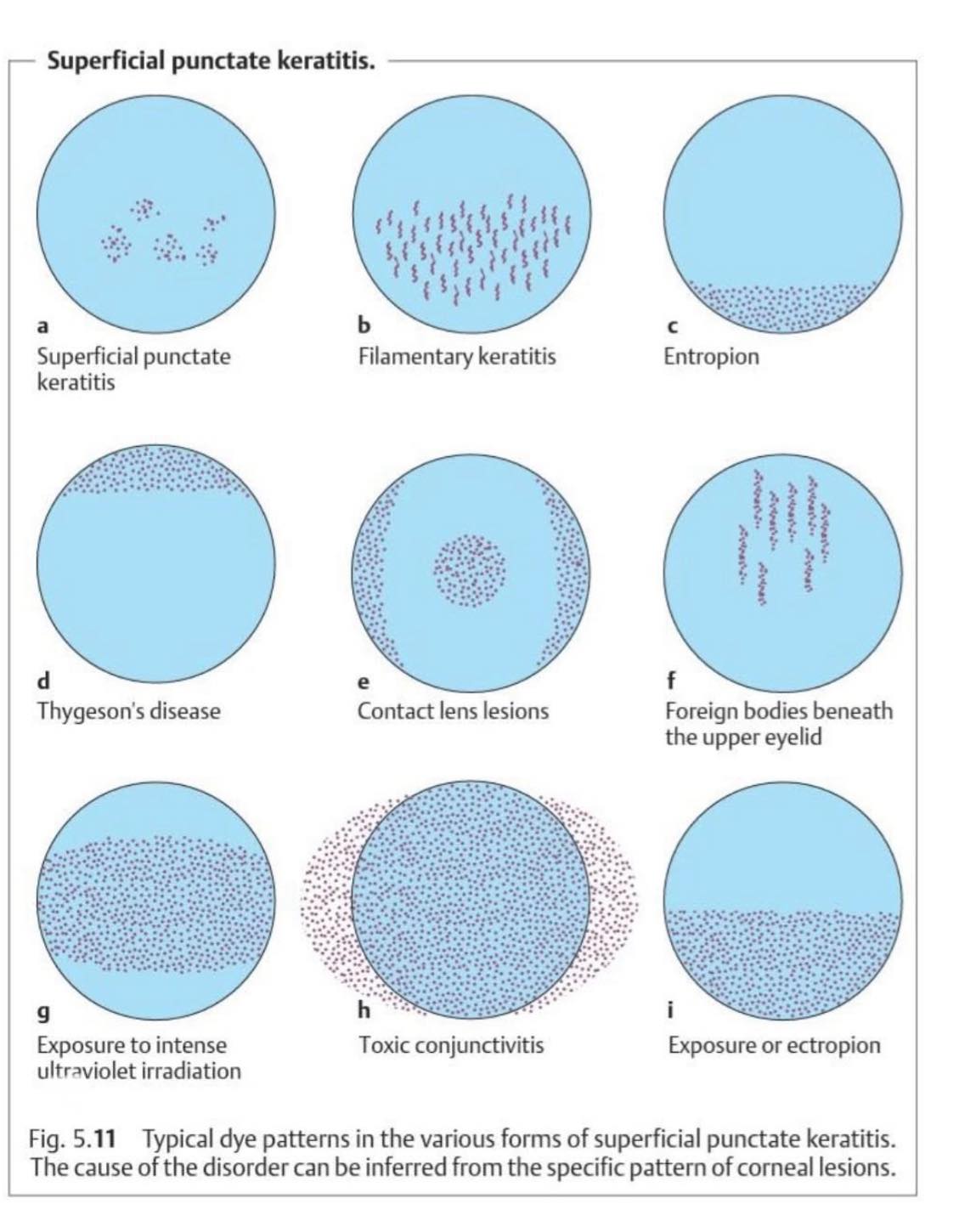 Typical Dye pattern in corneal lesion. - Optometry skills | Facebook