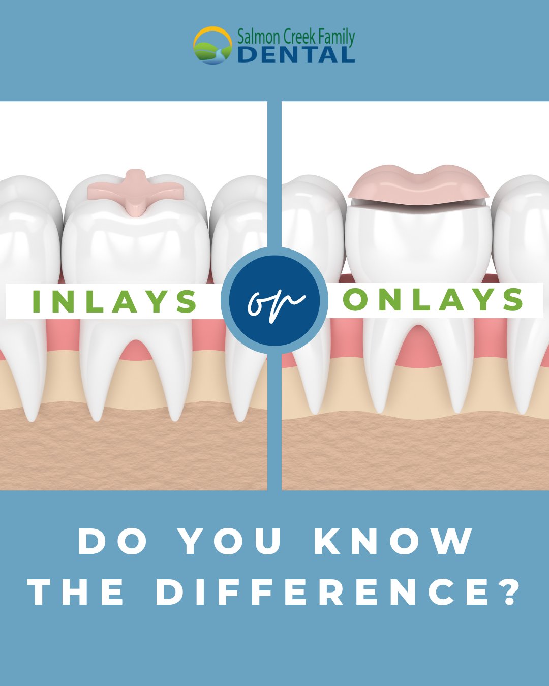 Salmon - Do you know the difference between inlays and onlays? Think of ...