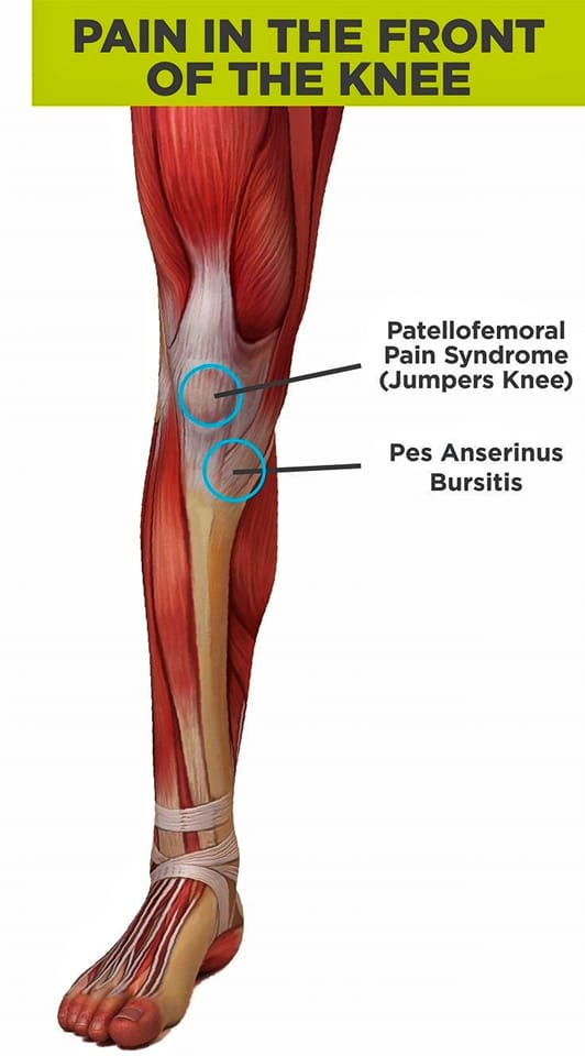 Movement Physiotherapy Clinic - 💥💥 Patellofemoral Pain Syndrome💥💥 ...