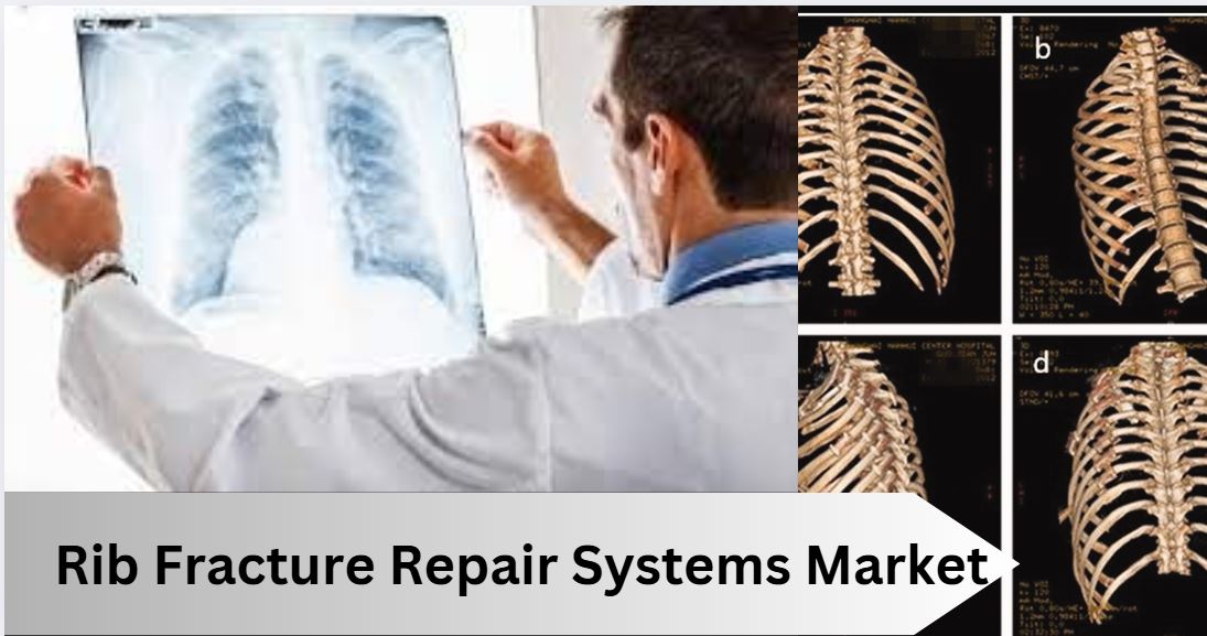 Credence - 🚑 The Rib Fracture Repair Systems Market: A Comprehensive ...