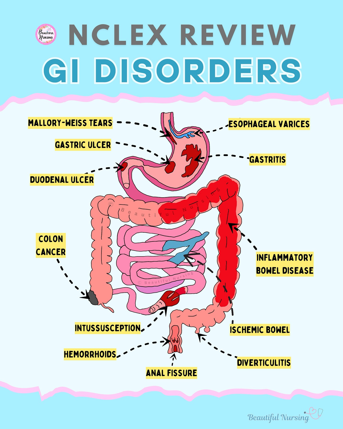 BeautifulNursing - Hallmark Signs of GI Disorders 🔥 💩 Crohn’s ...