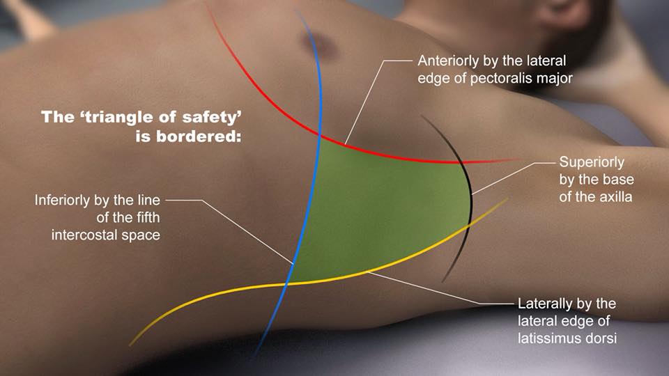 Medical notes - The safe triangle For tube thoracostomy | Facebook