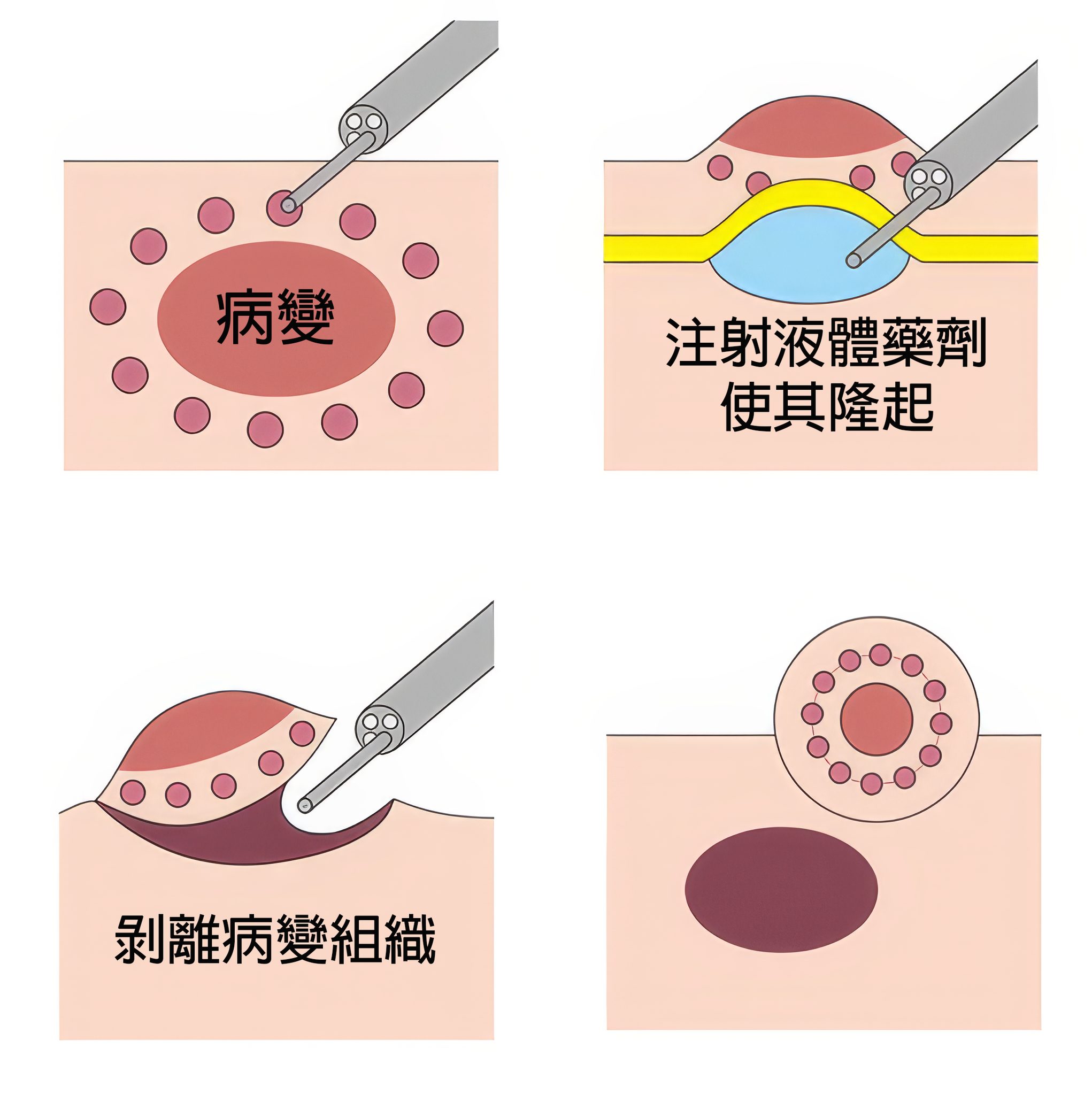和信醫院 - 和信治癌中心醫院 - 【守住癌前變化｜內視鏡黏膜下剝離術】... | Facebook