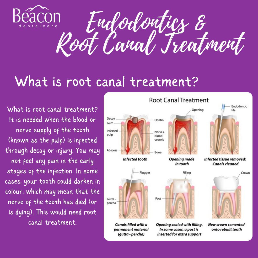 Beacon - What is root canal treatment? It is needed when the blood or ...