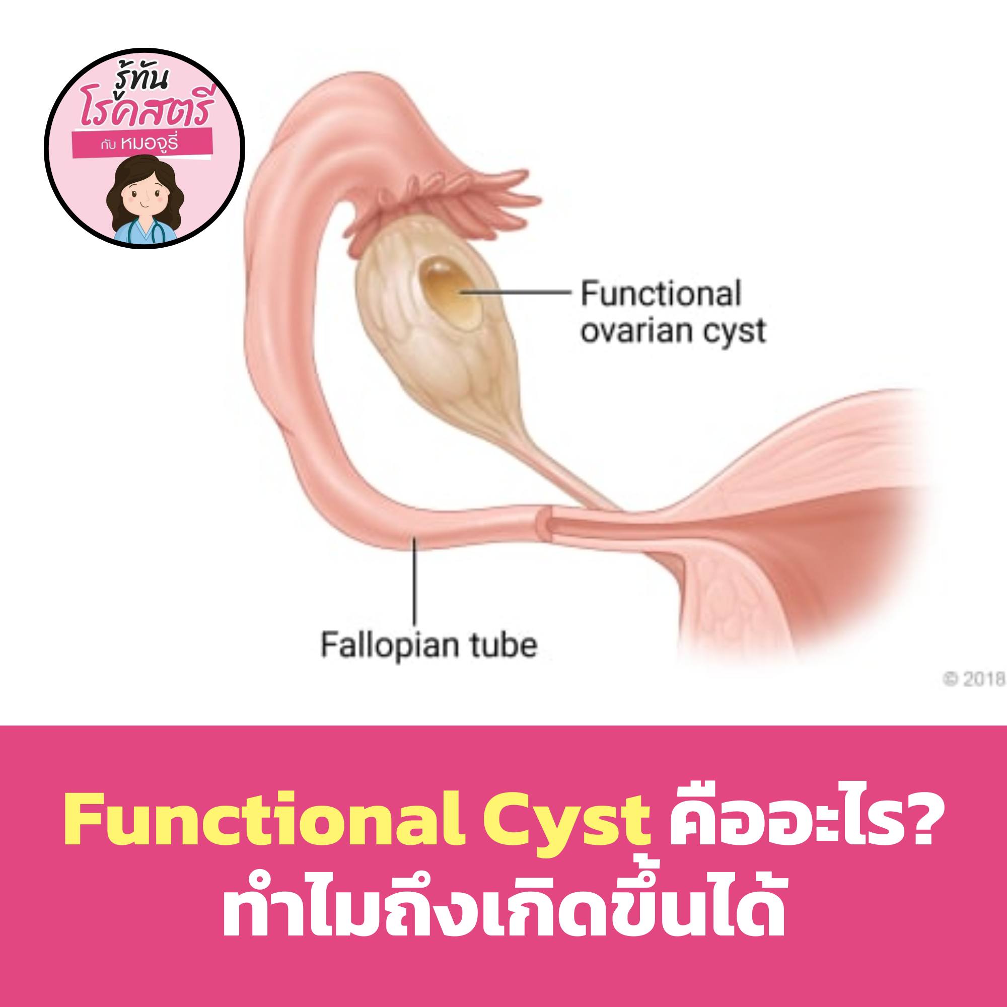 รู้ทันโรคสตรี - Functional cyst คืออะไร? ทำไมถึงเกิดขึ้นได้ 👉 ...