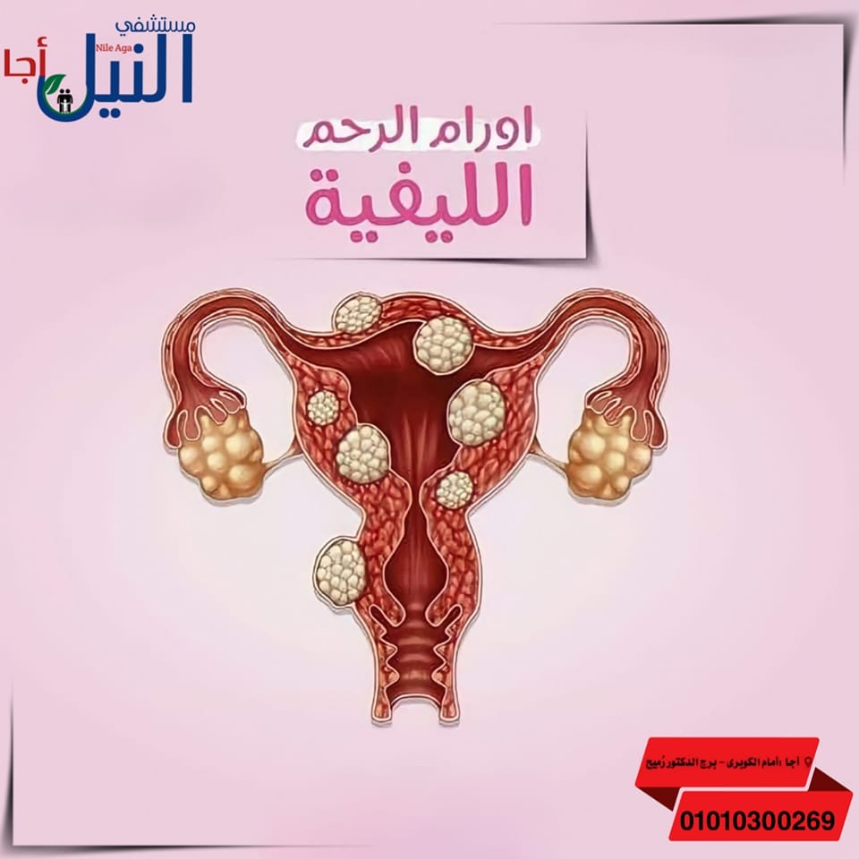 🔻 الأورام الليفية في... - د. يحيي رميح - مستشفى النيل بأجا | Facebook
