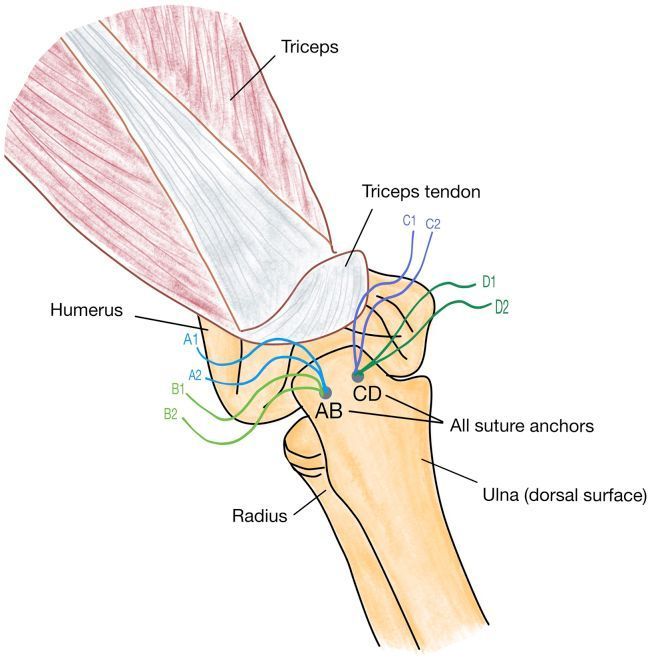 Professor - In this publication, we describe a Distal Triceps Rupture ...