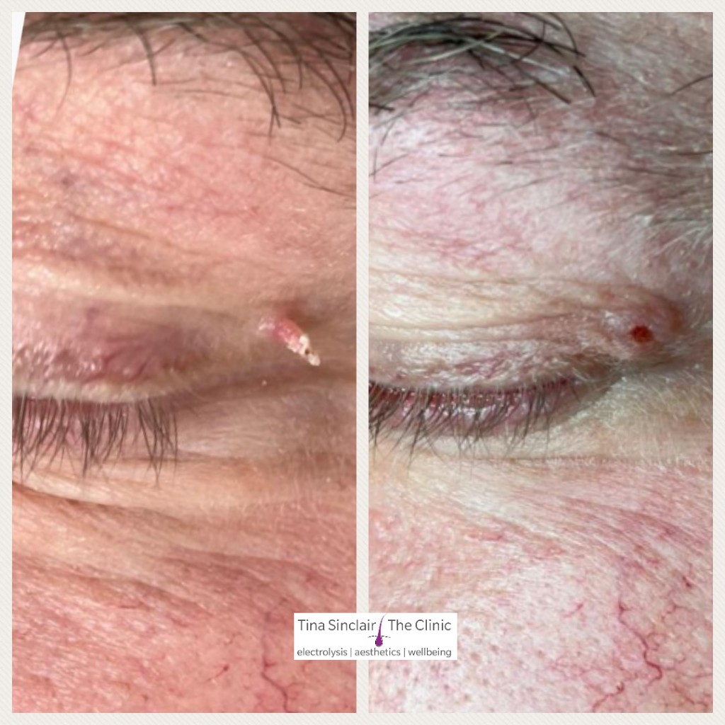 Tina - 🧐 Removal of a small skin tag which was elongated due to being ...