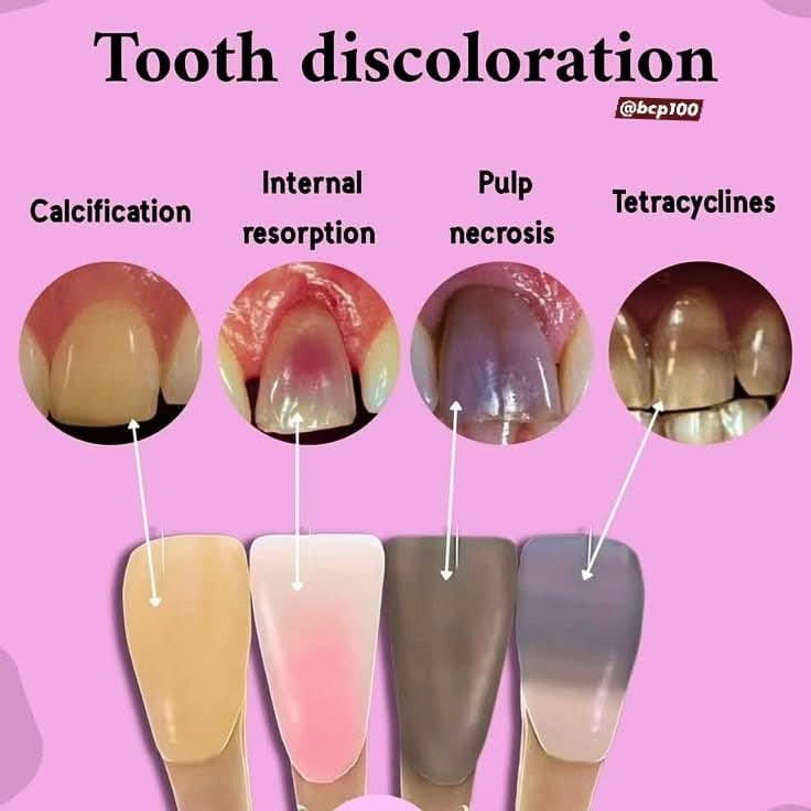 Living - Tooth Discoloration: Causes, Solutions, and Prevention ...
