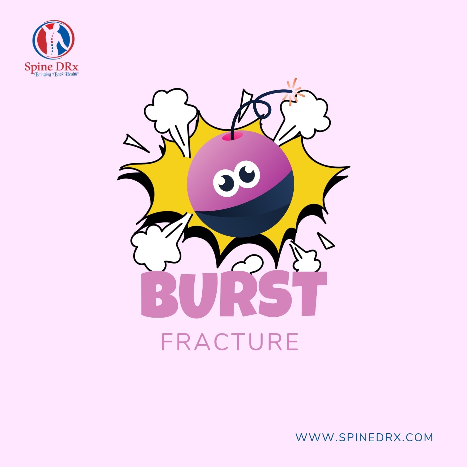 Spine - What is a burst fracture of the spine? Imagine a vertebra as a ...