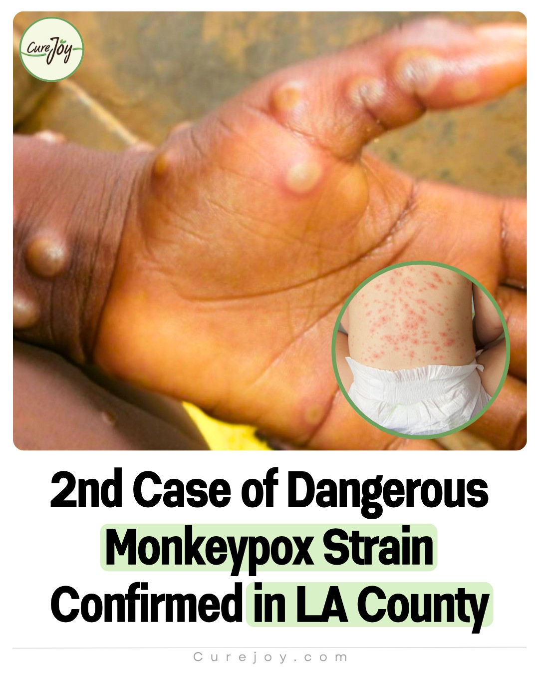 Curejoy - LA County reports its second case of the dangerous Clade I ...