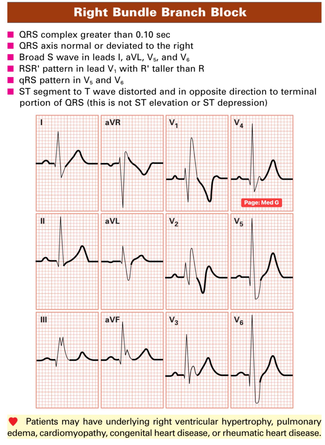 Med - Right Bundle Branch Block #ECG #ecgchallenge #ecginterpretation ...