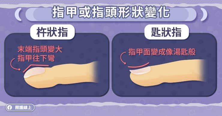 白映俞 - 杵狀指通常是經過數年的時間變化，因此患者很可能沒有發覺。不過，杵狀指還挺有特色的，末端指頭變大，指甲往下彎... | Facebook