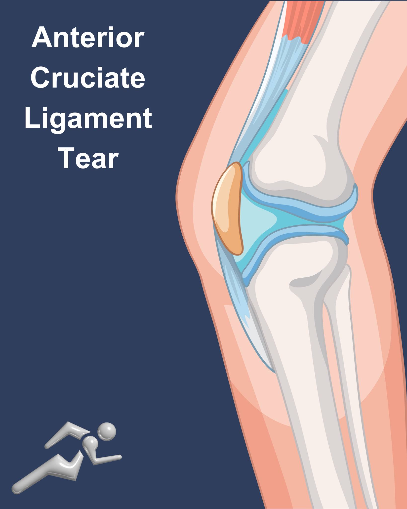 Advanced - We see a lot of ACL injuries...the anterior cruciate ...