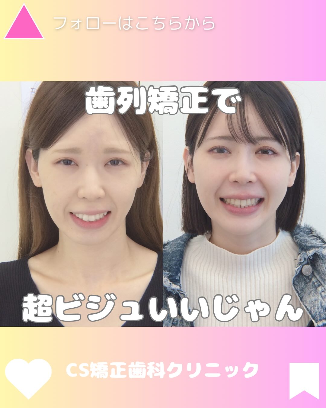 歯科 矯正 可愛く なっ た
