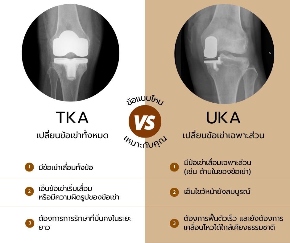 UKA vs. TKA:... - คลินิกกระดูกและข้อ หมอคณินทร์ | Facebook