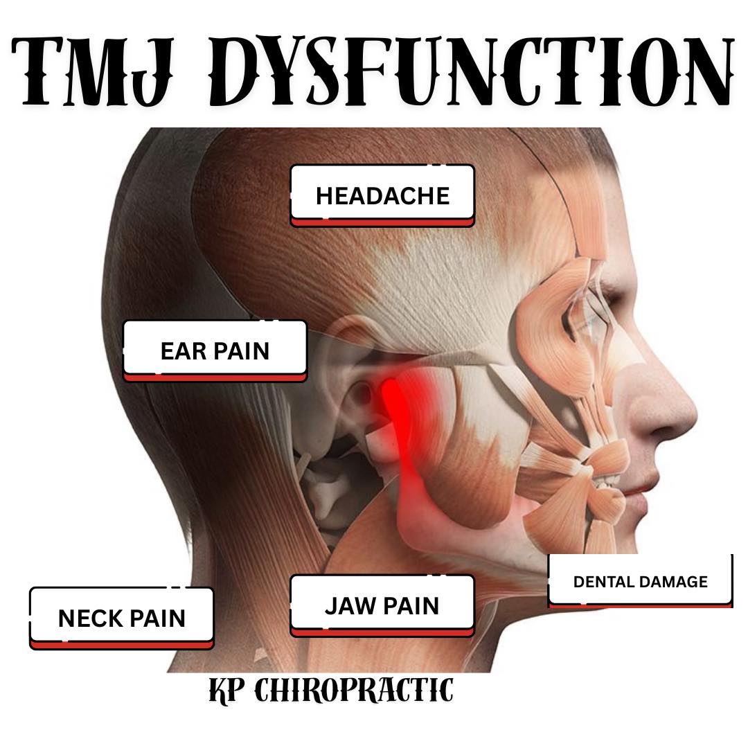 KP - Temporomandibular Joint (TMJ) Dysfunction, is a painful syndrome ...