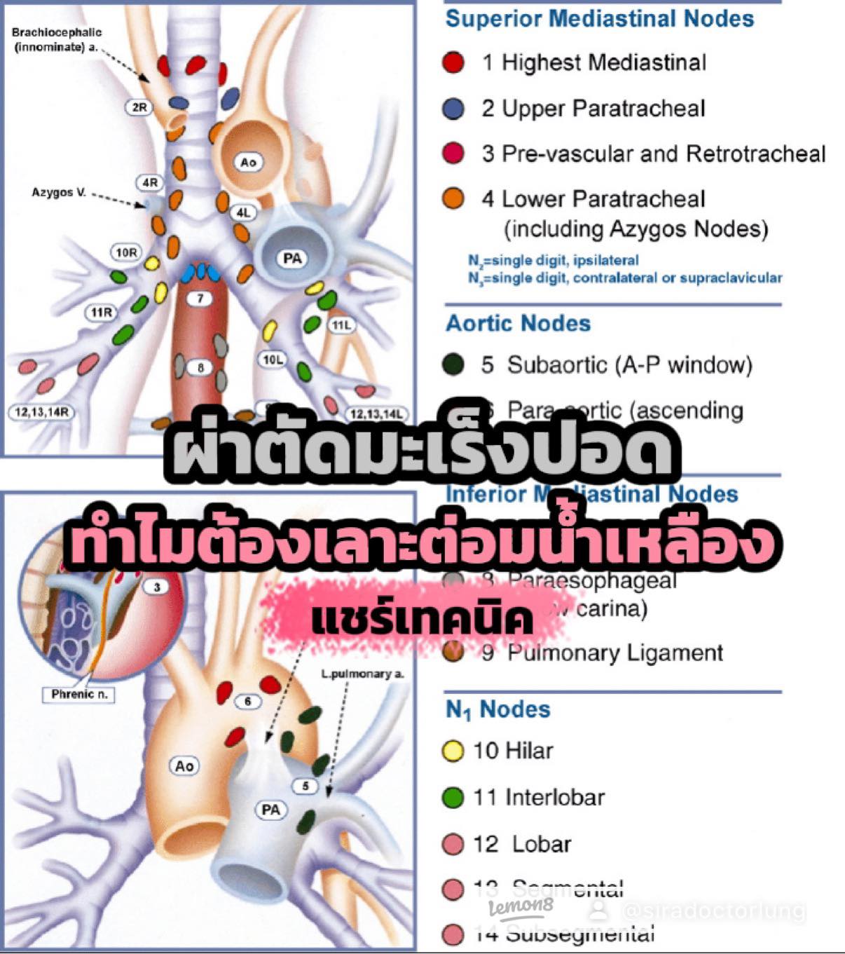ผ่าตัดปอดและหัวใจ - 🔴ต่อมน้ำเหลือง (Lymph node) คือ อวัยวะเล็ก ๆ รูป ...
