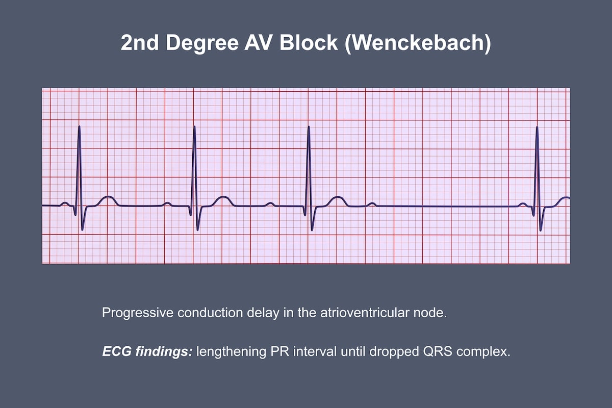 Second-Degree Heart Block... - Respiratory Therapy Zone | Facebook