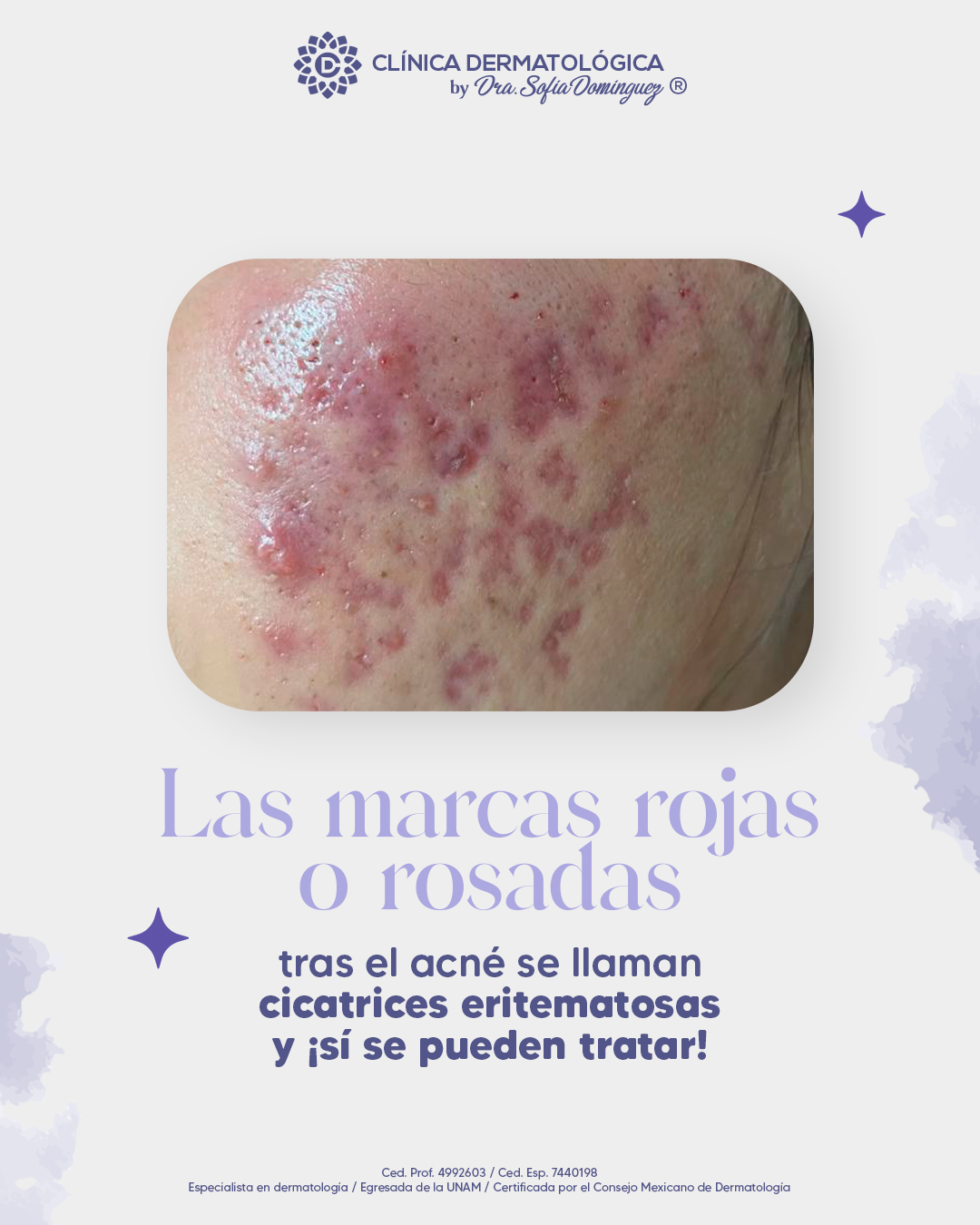 Dermatóloga - Las marcas rojas o rosadas tras el acné se llaman ...
