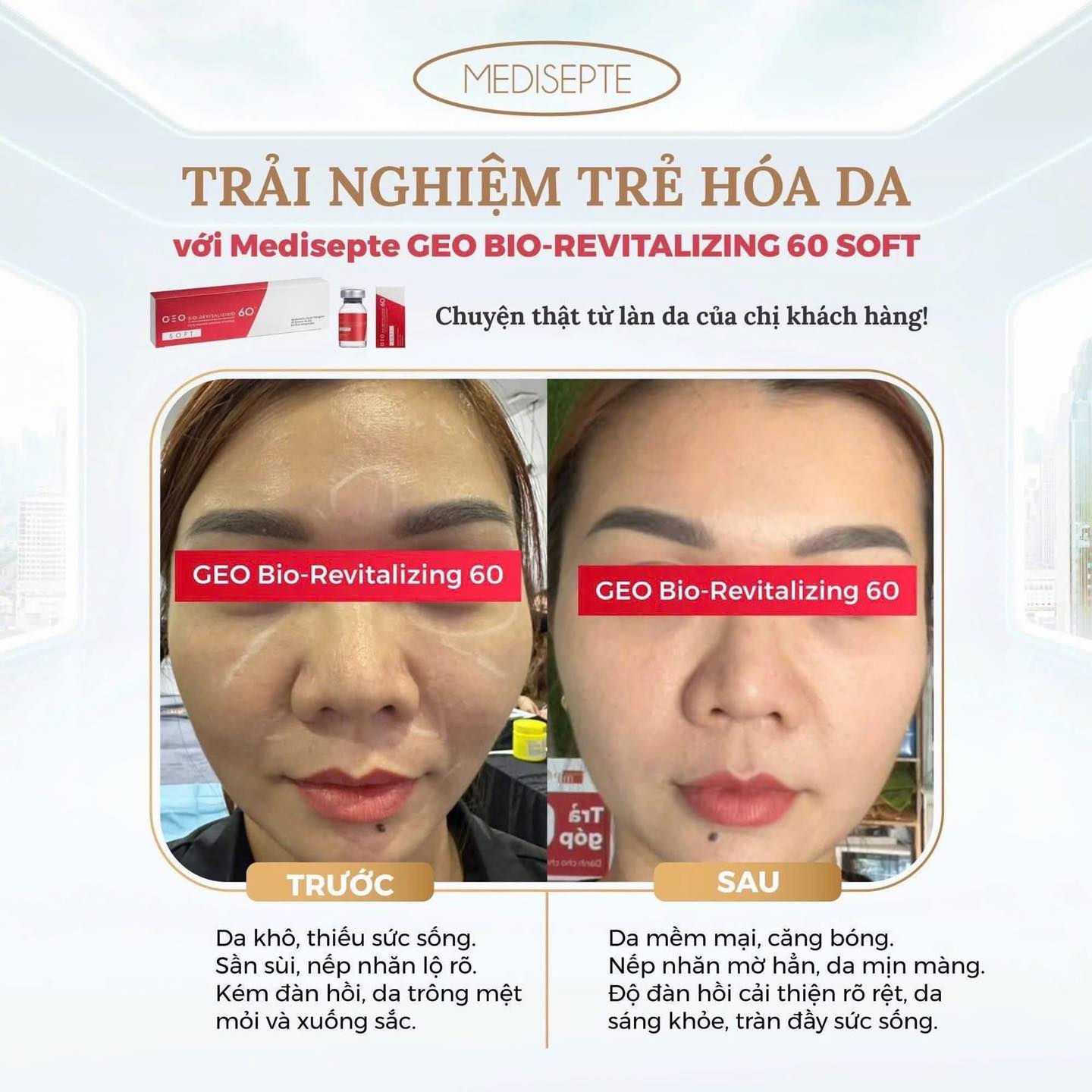 Serum hydro B5 - ⚡ GEO BIO REVITALIZING 60™ – SKIN BOOSTER... | Facebook