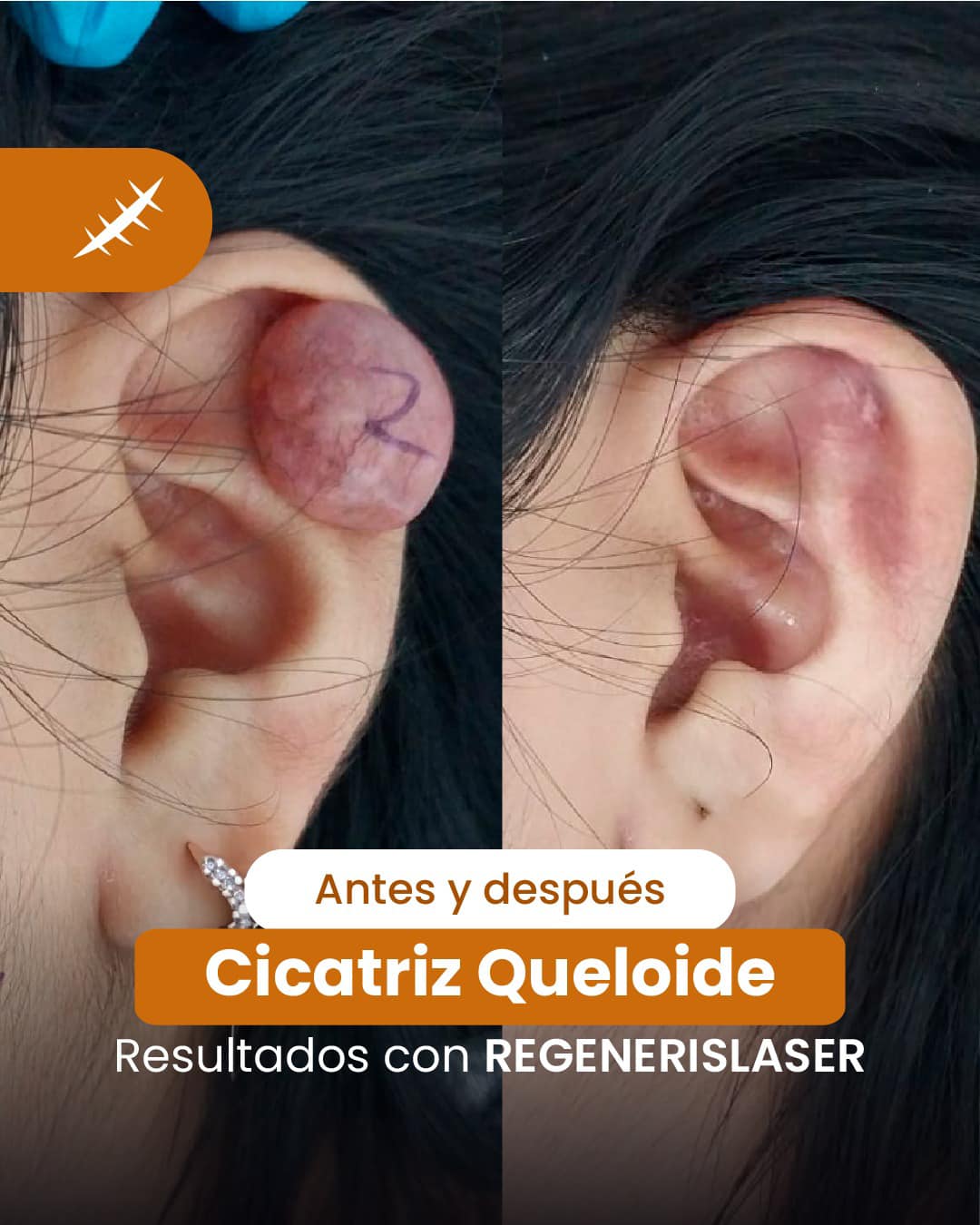 Skin Medical Centro Laser - ¡Transformación impresionante! 👏 Este antes ...