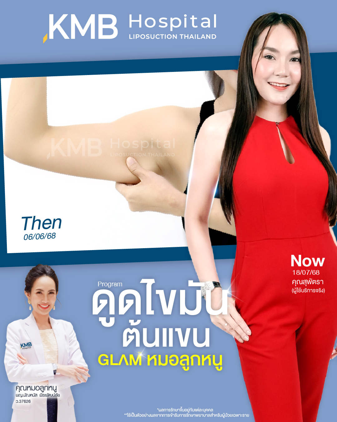 KMB - 𝙐𝙥𝙙𝙖𝙩𝙚 🥰 ผลลัพธ์ โปรแกรม #ดูดไขมันต้นแขน ʀᴇᴠɪᴇᴡ จากเคสจริง ที่ ...